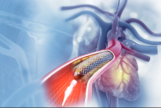 Cardiac Catheterization vs. Angioplasty