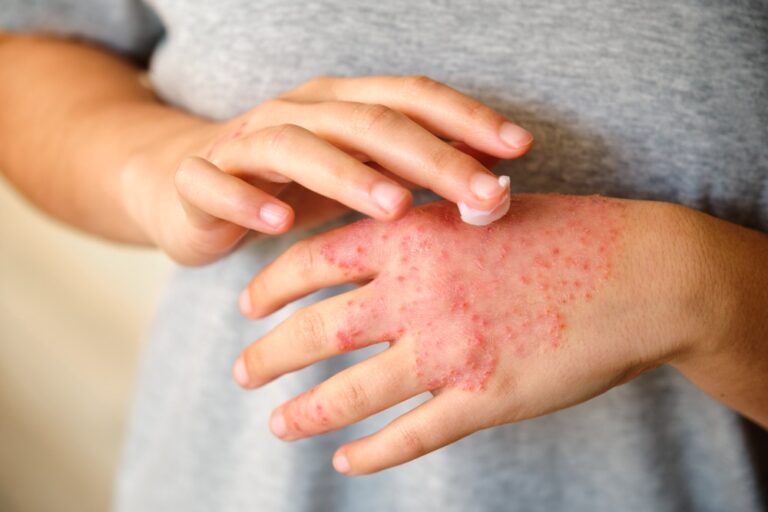 Eczema in Winter: Tips for Relief